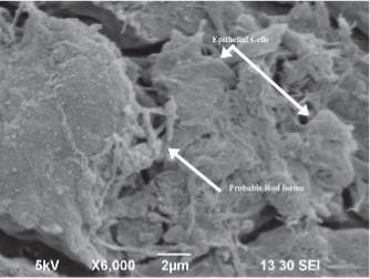 SEM-image: Bacteria in fissures on mattress surface caused by disinfectant damage.